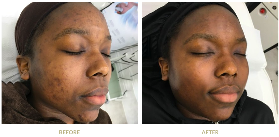 What is an Obagi Blue Radiance Chemical Peel?